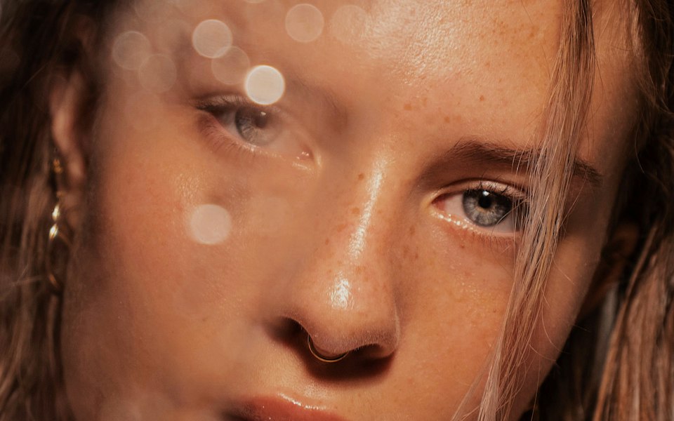 Melasma & pigmentation treatment